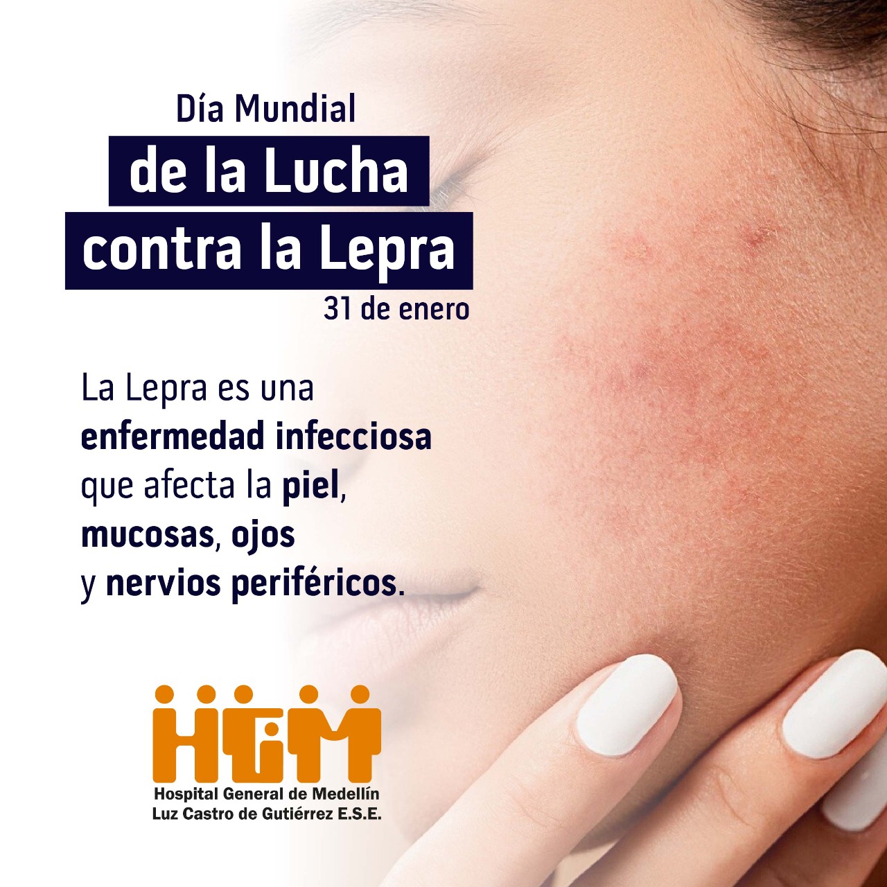 31 de enero Día Mundial Contra La Lepra